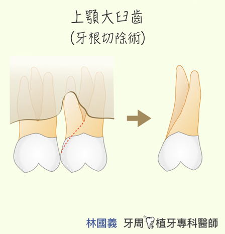 牙根斷裂怎麼辦?一定要拔牙嗎?常見症狀與治療選擇