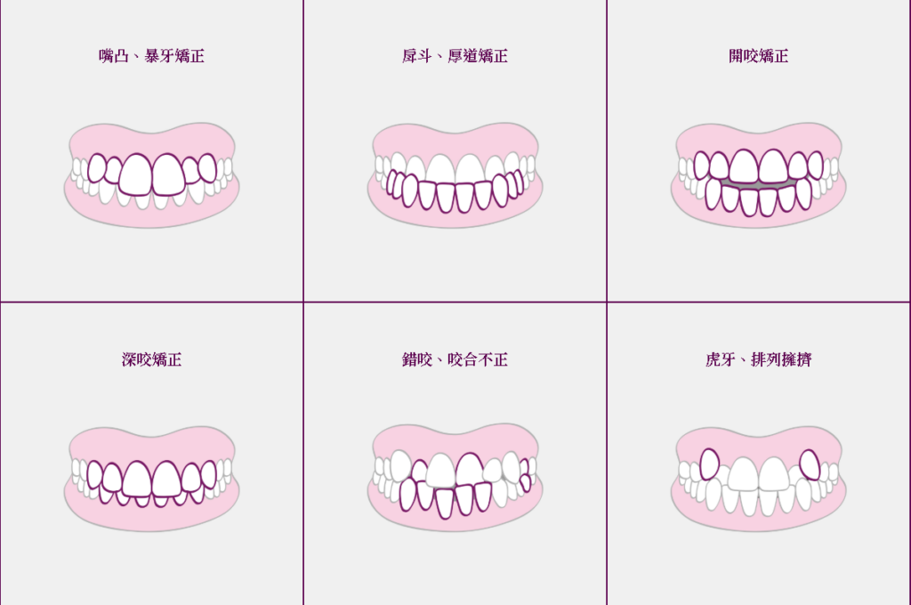 常見的咬合不正類型