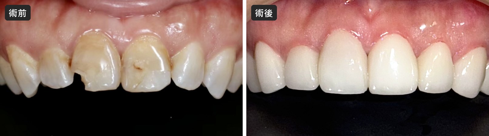 門牙缺角與蛀牙破洞,陶瓷貼片術前術後